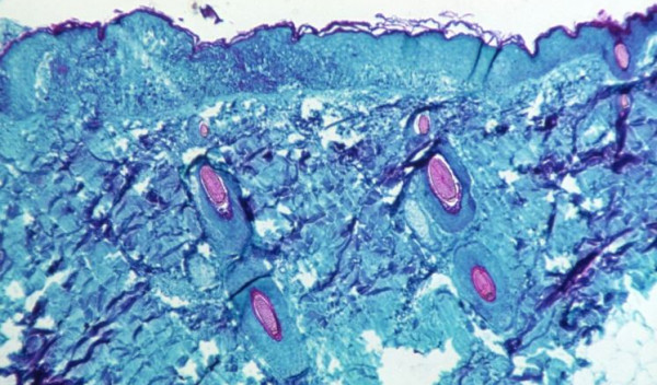 Monkeypox virus outbreaks are containable: WHO